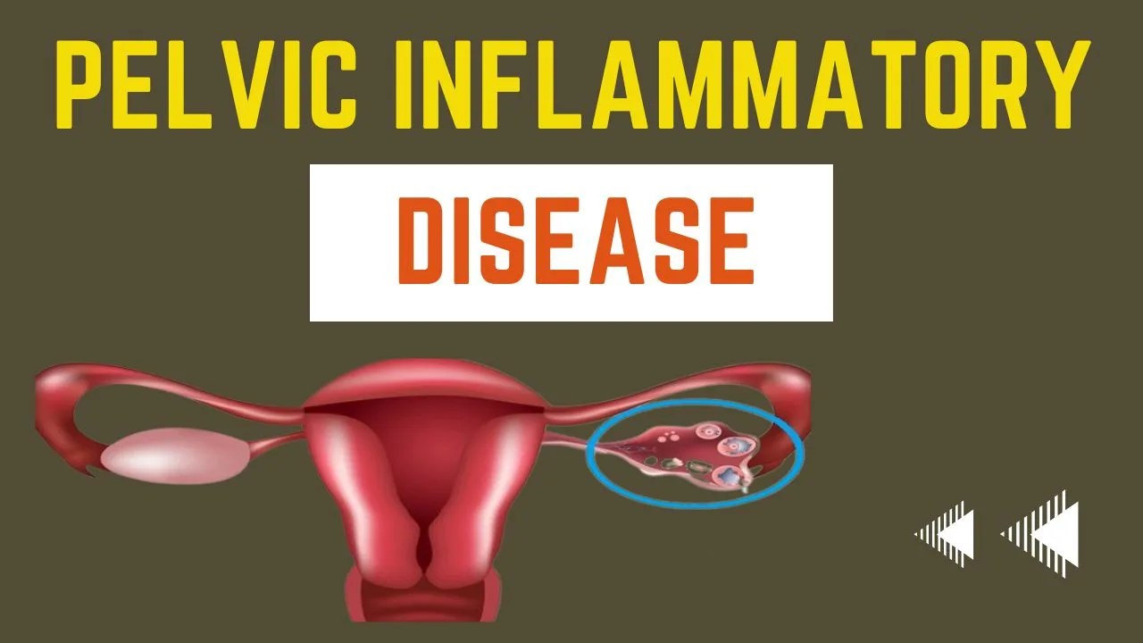 Pelvic Inflammatory Disease: Causes, Symptoms, Treatment, And ...